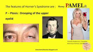 Mnemonics  Horners syndrome [upl. by Oflodor]