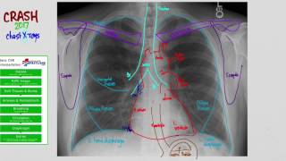 01 CXR Anatomy [upl. by Delos]