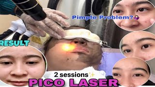 PICO LASER PROCEDURE  HOW DOES IT WORK  PHILIPPINES [upl. by Wenoa]