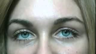 Bright Ocular surgery to change your eye color permanently to ice gray [upl. by Ardnek]