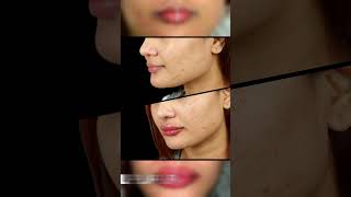 Plump amp Perfect Lips with Lip Enhancement by Dr Adarsh Tripathi  Sarayu Clinics lipfiller [upl. by Christel673]