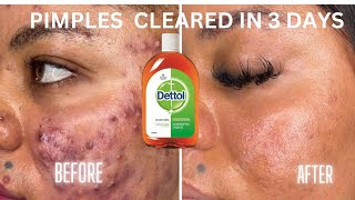 HOW TO CLEAR PIMPLES AND ACNE IN 3DAYS USING DETTOL ANTISEPTIC ✨ [upl. by Lillie981]