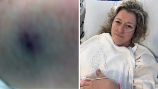 Mother Talks About Surviving Funnel Web Spider Bite [upl. by Brynn]