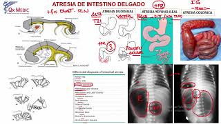 Atresias Intestinales [upl. by Ziladnerb]