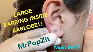 Giant earring completely hidden inside earlobeForeign body popMetal extractionMust see to believe [upl. by Herald53]