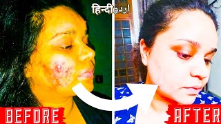 MAGIC PILL TO HEALGET RID OF ACNE FAST  WHAT TO EAT  VITAMIN B5 PANTOTHENIC ACID URDUHINDI [upl. by Ymmat]