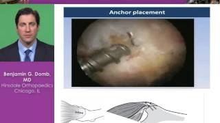 Gluteus Medius Tears Techniques and Indications [upl. by Demmahom]