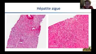 Webinaire hépatologie et hématologie [upl. by Harland399]