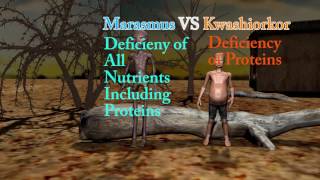 Marasmus Difference Between Marasmus Cachexia and Kwashiorkor [upl. by Jessa739]