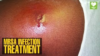 MRSA Infection Treatment  Health Tips  Education [upl. by Tirza]