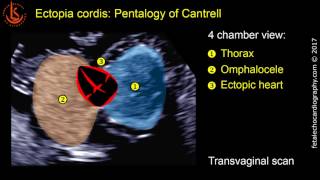 Fetal echocardiography at 1113 weeks Ectopia Cordis in Pentalogy of Cantrell [upl. by Henrion391]