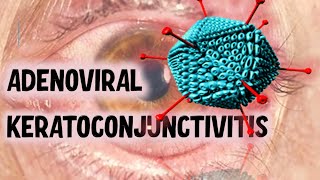 VIRAL CONJUNCTIVITIS  Ultimate Guide to Recognising Clinical Presentations [upl. by Goldia]