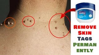 REMOVE SKIN TAG IN 1 NIGHT BY APPLYING VASELINE [upl. by Aliza]