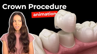 Dental Crown Procedure at the Dentist [upl. by Aguie]