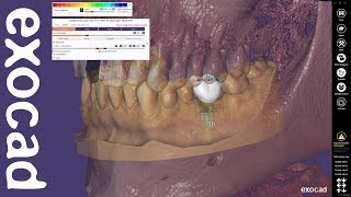 exocad Quick Guide Using the Immediate Load feature in combination with exoplan [upl. by Aicilla]