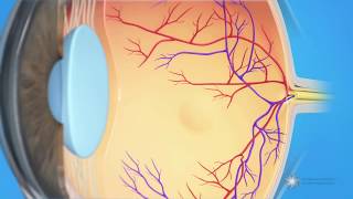 What is cystoid macular edema [upl. by Emelia226]