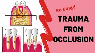 Trauma From Occlusion TFO  PERIODONTOLOGY [upl. by Elumas]