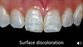 Case Selection for Enamel Microabrasion [upl. by Miller]