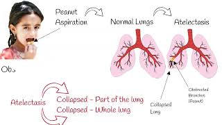 Atelectasis  signs and symptoms Mechanism of atelectasis explained simply [upl. by Clevie726]