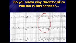 Emerg Med Cardiology Course  feat Dr Amal Mattu [upl. by Andre992]