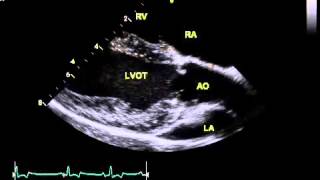 Normal canine echo  right parasternal long axis LVOT view [upl. by Aseiram]