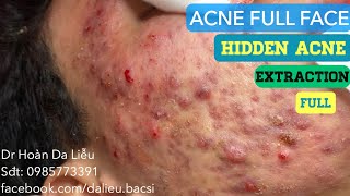 Nặn mụn nhọt áp xe đầy mặt cho nam sinh viênSqueeze pimples anti acne severe blackheads full [upl. by Adnohr]