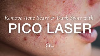 Pico Laser The Solution for Acne Scars Dark Spots amp Enlarged Pores [upl. by Mich370]