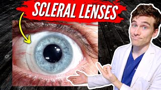 Scleral Lenses for Keratoconus 7 Facts You Need to Know [upl. by Vitek]