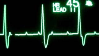 3rd Degree Atrioventricular Block [upl. by Meehahs455]