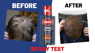 I used quotAlpecin Caffeine Shampooquot for 30 days Heres what happened [upl. by Enej955]