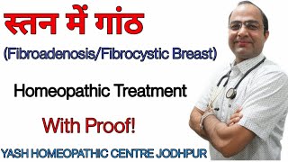 Breast Lump treatment । स्तन मे गाँठ का ईलाज ।fibroadenoma breast homeopathic treatment [upl. by Giglio]