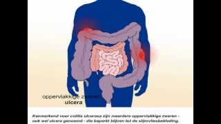 Colitis ulcerosa  Wat zijn de symptomen en behandeling van colitis ulcerosa [upl. by Christenson949]