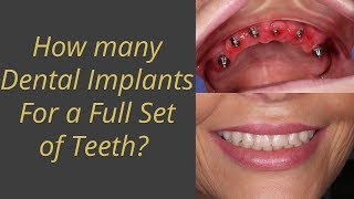 How many implants are needed to replace a full set of teeth [upl. by Nonnac997]