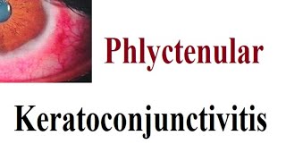 phlyctenular Keratoconjunctivitis [upl. by Assirralc]