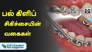 பல் கிளிப் சிகிச்சையின் வகைகள்  Types of Orthodontic Treatment [upl. by Milena732]