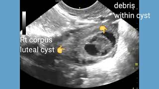 Viable intrauterine pregnancy with corpus luteal cyst of ovary ultrasound and color Doppler video [upl. by Laddie439]