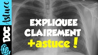 🔴6 APPRENDRE LE SYNDROME ALVEOLAIRE EN 5MIN  partie 2  DR ASTUCE [upl. by Assirat]