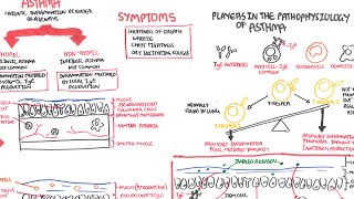 Asthma  signs and symptoms pathophysiology [upl. by Smukler]