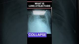 How To Remove Mucus from Lungs I Collapsed Lung I Atelectasis I Treatment [upl. by Innes]