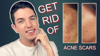 How to Get Rid Rid of Acne Scars Completely [upl. by Oeht402]