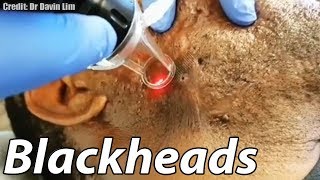 Worst Cystic Acne Biggest Blackheads and GIANT Cyst Removal [upl. by Nabla49]