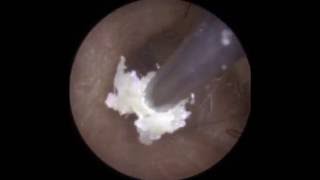 Endoscopic Suction of Debris on Infected Eardrum Fungal  Mr Neel Raithatha THC [upl. by Coben]