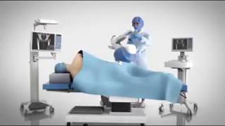 Stryker Mako robotic arm assisted total hip replacement [upl. by Merari694]