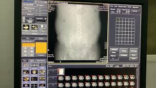 Intravenous Pyelogram I CECT KUB  CT Pyelogram CTU planning and procedure discoveryzsm7667 [upl. by Francene]