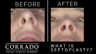 What is a Deviated Septum and How Does a Septoplasty Surgery Help  Dr Anthony Corrado [upl. by Aerdnwahs117]