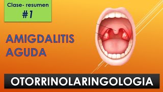 AMIGDALITIS AGUDA OTORRINOLARINGOLOGIA 1 [upl. by Coombs]