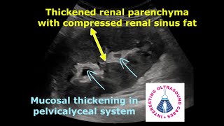 PYELONEPHRITIS ON ULTRASOUND  4 Different Cases  Emphysematous pyelonephritis [upl. by Jordans]