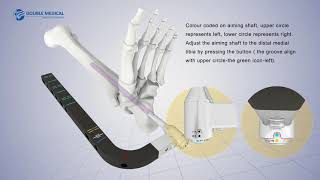 SuturePlate™ II Patella Fracture Repair System [upl. by Sutton]