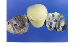 8Resin Bonded Bridge part ll [upl. by Ostraw]