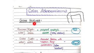 Colon Adenocarcinoma  Morphology [upl. by Arobed228]